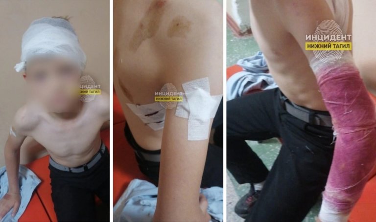 В Свердловской области бойцовская собака покусала 10-летнего ребенка
